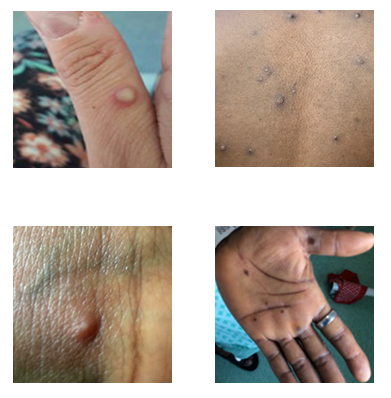 Collage of monkeypox characteristics including rashes and lesions on different parts of the body 